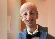 Perjuangan Melawan Progeria, Upaya Ilmuwan dan Kisah Hidup Sammy Basso