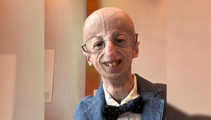 Perjuangan Melawan Progeria, Upaya Ilmuwan dan Kisah Hidup Sammy Basso