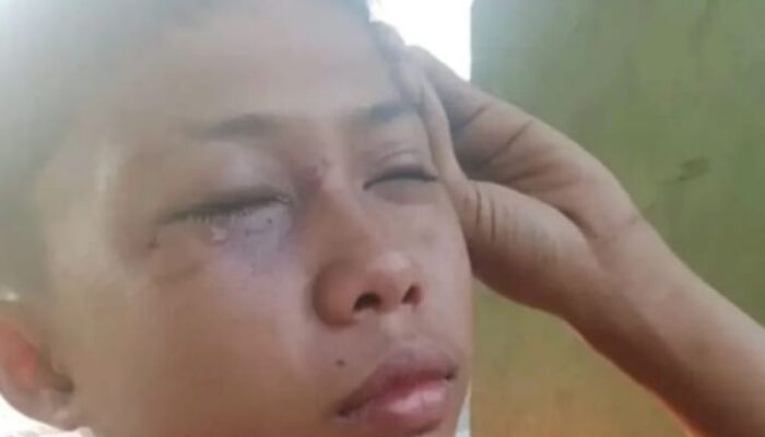 Bocah Bermata Lebam Diduga Dipukul Oknum Aparat, Propam Polda Riau Turun Tangan