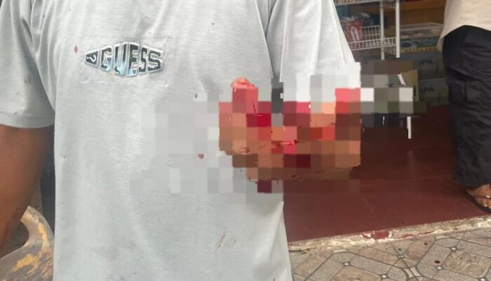Tragis! Jari Telunjuk Pria Pekanbaru Putus Digigit, Keluarga Masih Tunggu Keadilan